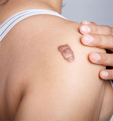 Keloid Treatment