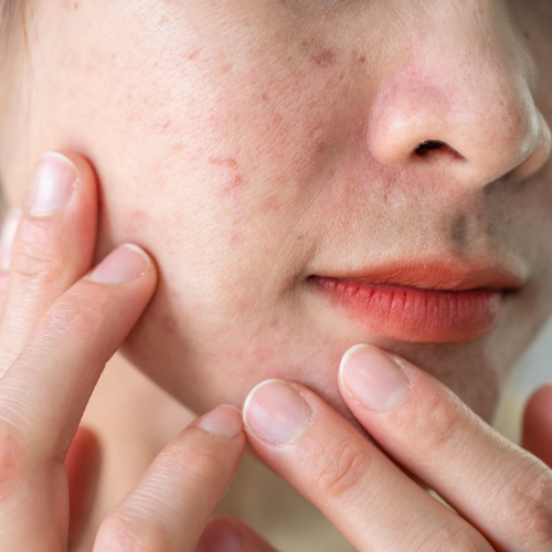 Skin Damage