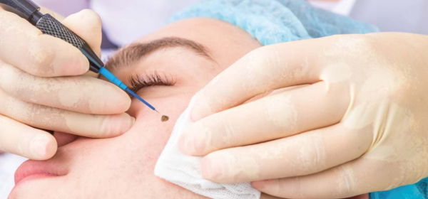 Electrosurgery
