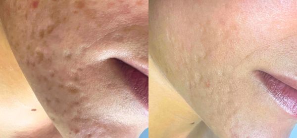 Fractional CO2 Laser