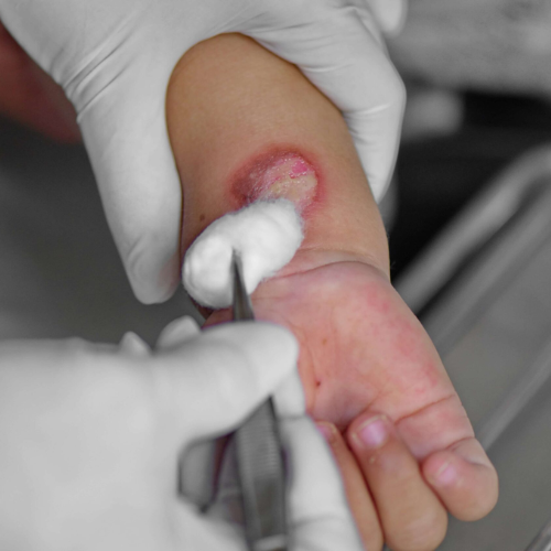 Immediate Burn Care