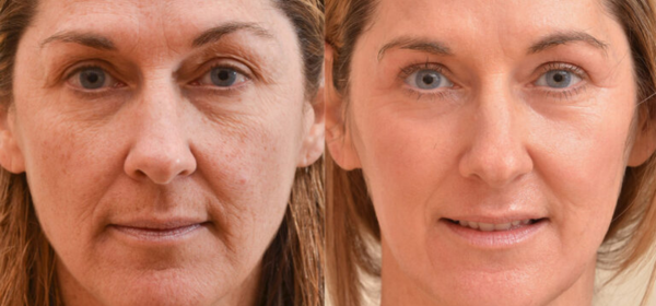 Laser Skin Resurfacing