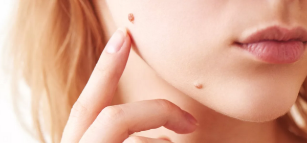 Laser Removal