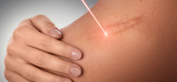 Laser Therapy