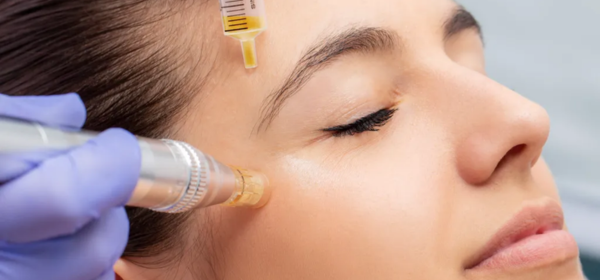 Chemical Peels