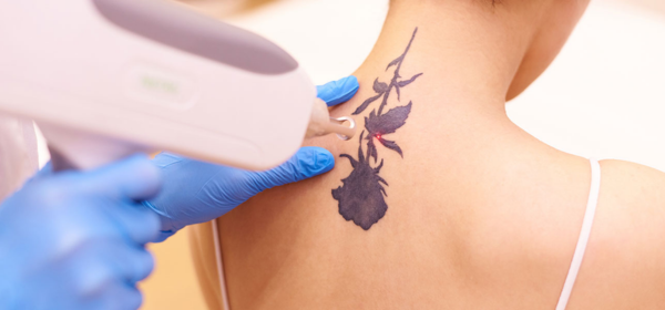 Q-Switch Nd:YAG Laser