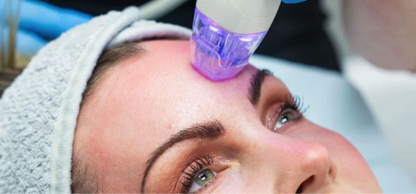 Radiofrequency Microneedling