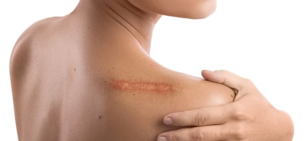 Steroid Injections