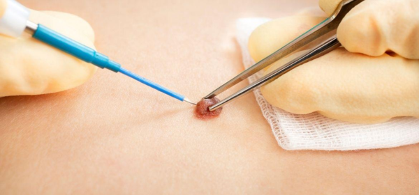 Surgical Excision