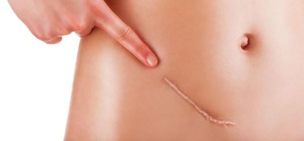 Surgical Scar Revision
