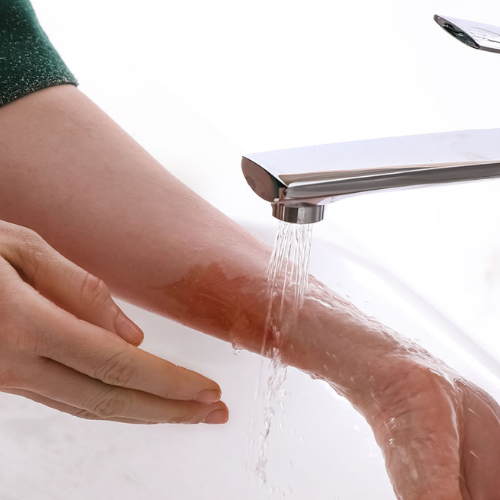 Burns Treatment