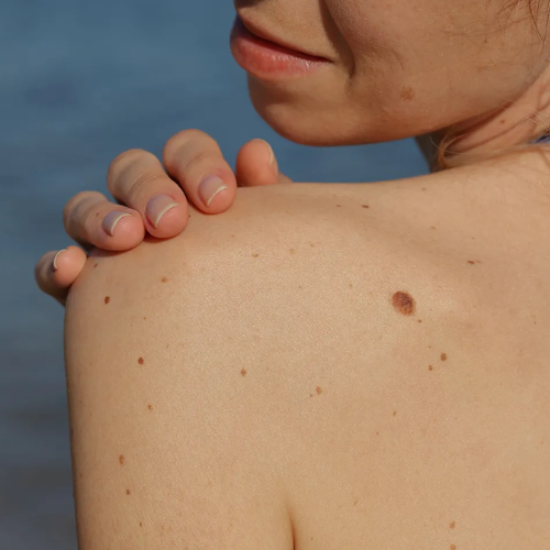 Mole Removal
