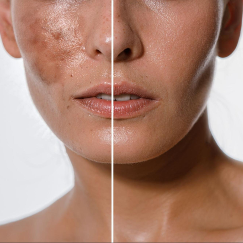 De-Pigmentation Treatment