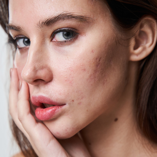 Scar Treatment