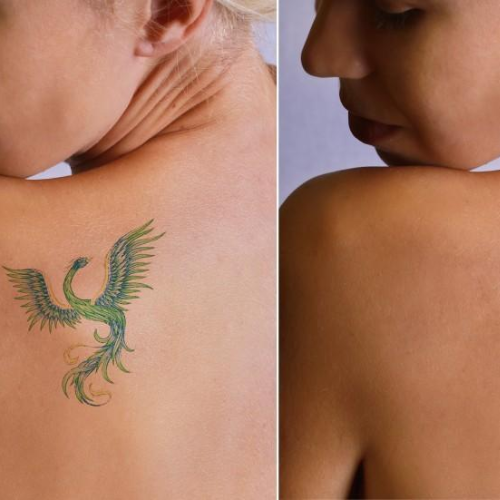 Tattoo Removal