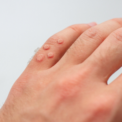 Warts Removal