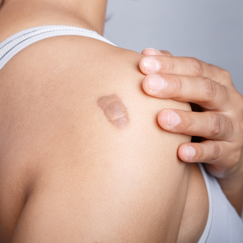 Keloid Treatment