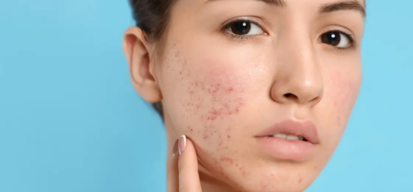 Acne Treatment