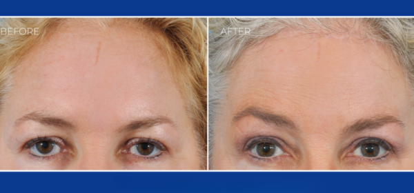 Before Treatment
