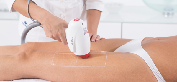 Laser Hair Removal