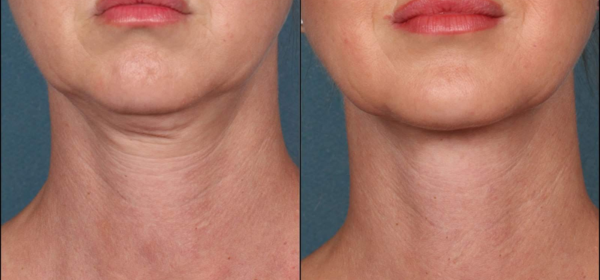 Before Treatment
