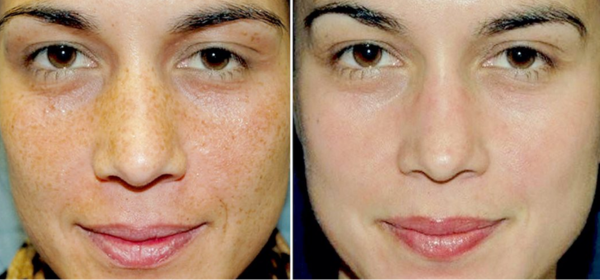 Before Treatment