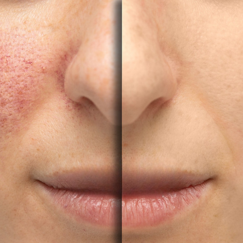Fractional CO2 Laser System