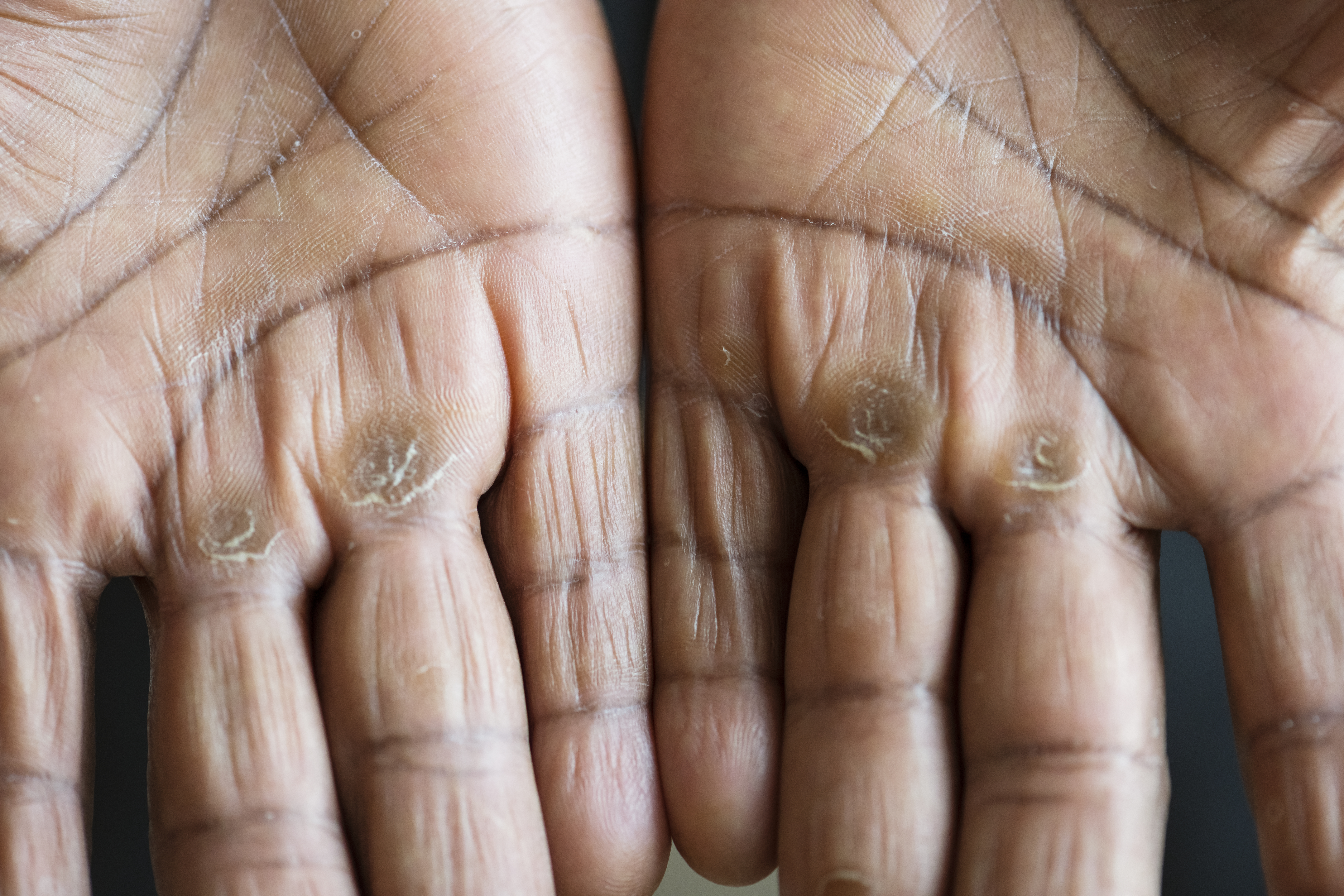 Fungal Infection Treatment