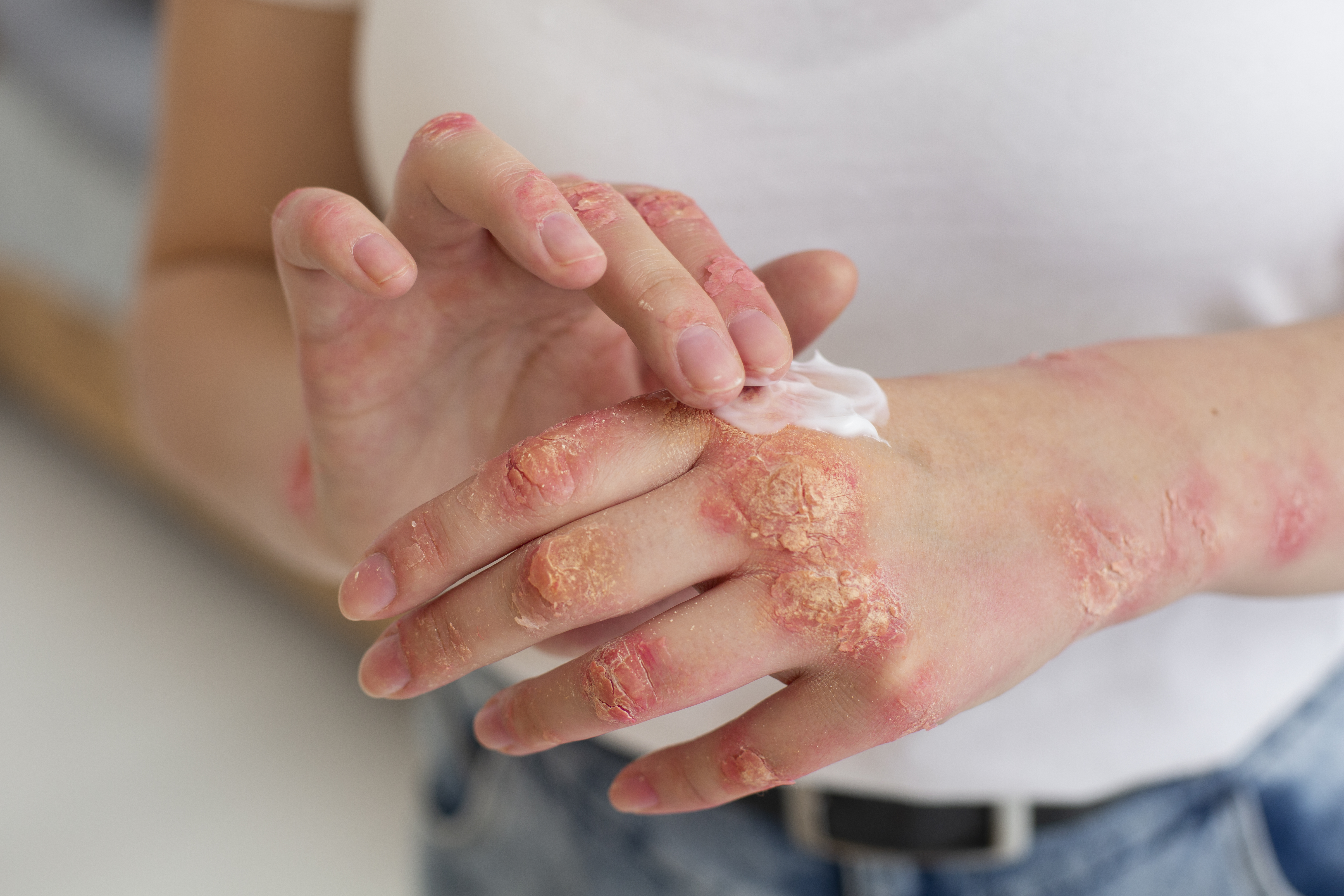 Eczema Treatment