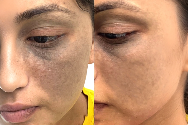 After Treatment