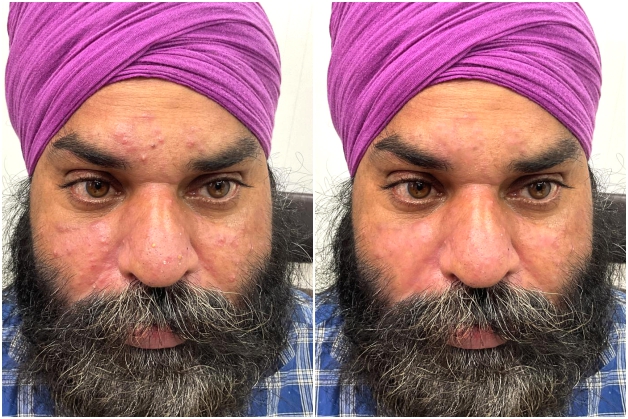 After Treatment