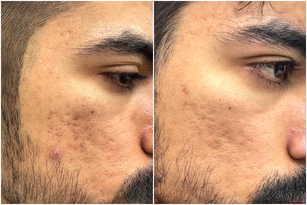 Before Treatment