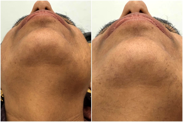 Before Treatment