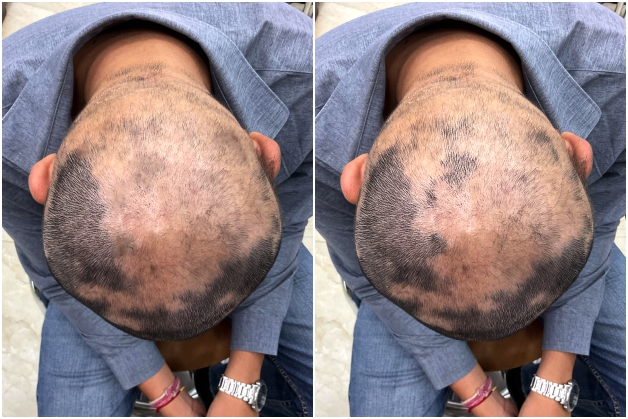 After Treatment