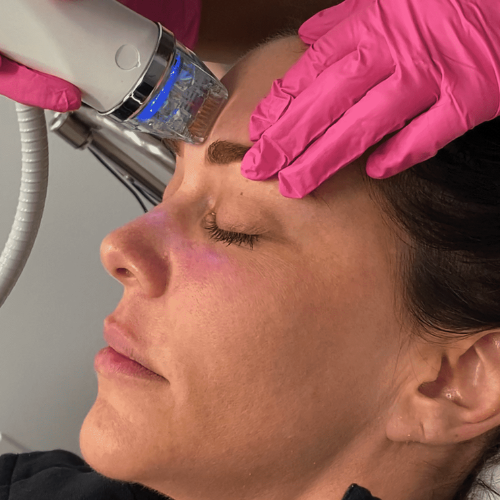 Secret RF Treatment Process